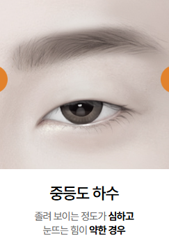 눈재수술 시 눈매교정이 꼭 필요할까? 관련 이미지 2