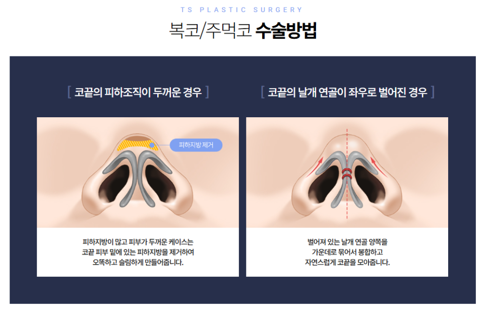 복코 코성형 지방 제거만으로 날렵해질 수 있을까? 코끝 연골 묶기와 박리의 진실 관련 이미지 2