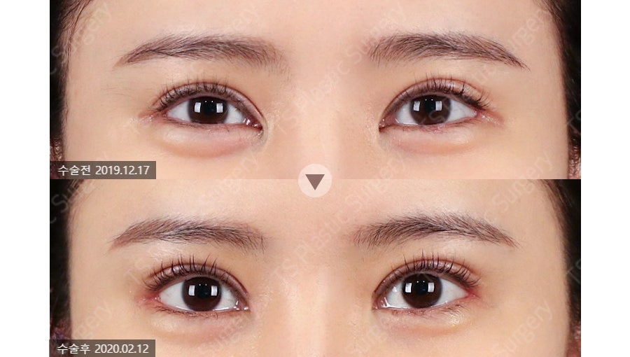 Can the Line Be Changed Because of an Epicanthoplasty Scar? How to Change It to an Outlined, Inline, or In-Out Line image 6