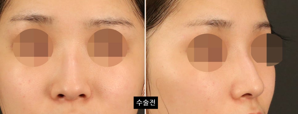 코수술 후 변화가 뚜렷하게 느껴지는 얼굴 유형 4가지 관련 이미지 3