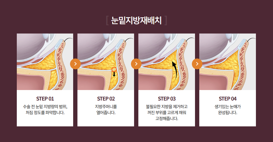 눈밑지방재배치 수술 후 다시 꺼져보인다면? 재발 원인부터 확인해야 합니다 관련 이미지 2