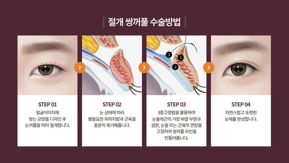 쌍꺼풀 수술 전, 쌍꺼풀 테이프는 언제부터 끊어야 할까요? 관련 이미지 3