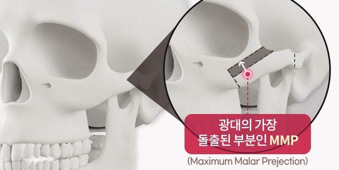 자연스러운 얼굴 라인을 위한 안전한 얼굴 윤곽 개선 방법 관련 이미지 3
