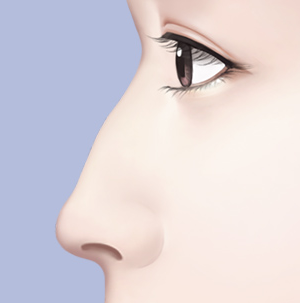Things to Consider When Thinking About Revision Surgery for a Hump Nose image 3