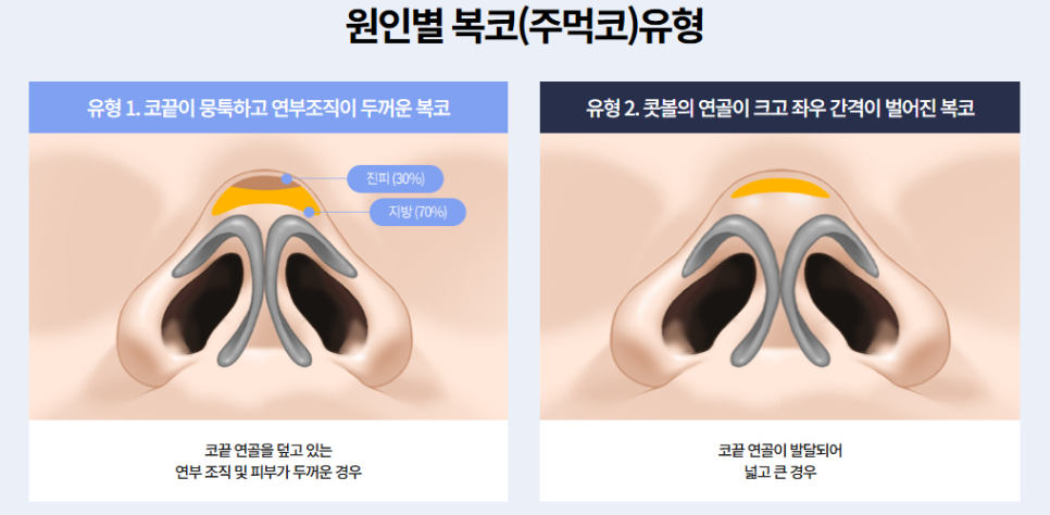 복코 코성형 지방 제거만으로 날렵해질 수 있을까? 코끝 연골 묶기와 박리의 진실 관련 이미지 1