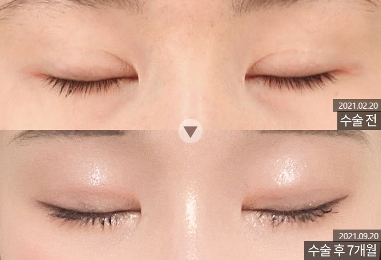 Revision Eyelid Surgery Case: Correcting an Eye Shape That Felt Heavy and Constricted Due to High, Thick Double Eyelids image 4