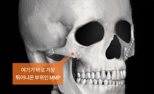광대축소수술에 효과적인 케이스와 수술 시 고정이 중요한 이유 관련 이미지 4