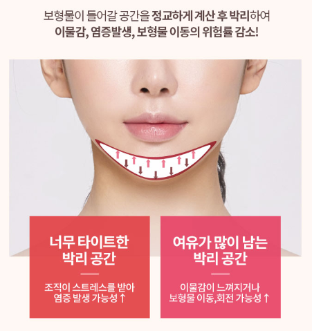 It Is Important to Perform Chin Augmentation with a Chin Implant by Considering Individual Facial Proportions image 5