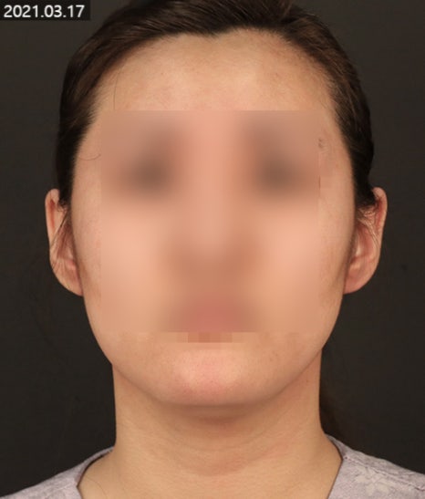 PureCell Fat Grafting: Fat Refinement and Grafting Techniques image 1