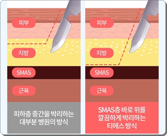안면거상술의 비밀 그리고 안면거상 할 때 유의할 점이라면 관련 이미지 17