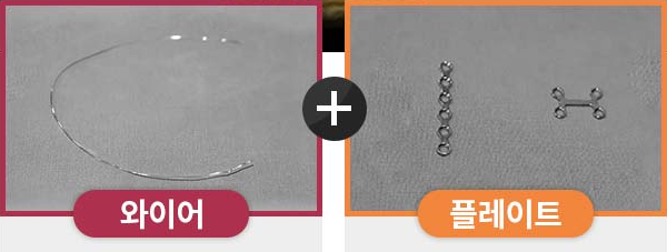 Key Points to Check Before Cheekbone Reduction Surgery image 3