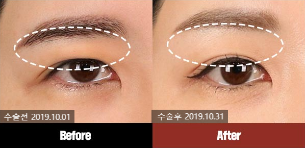 20~30대 이마리프팅 왜 필요할까? 관련 이미지 3