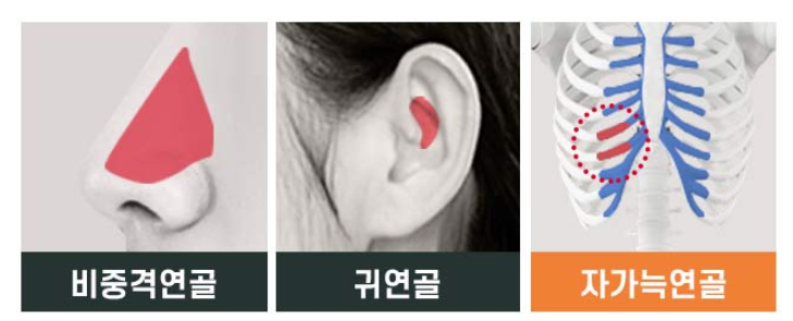 무보형물 코성형으로 부작용 걱정이 된다면 관련 이미지 3