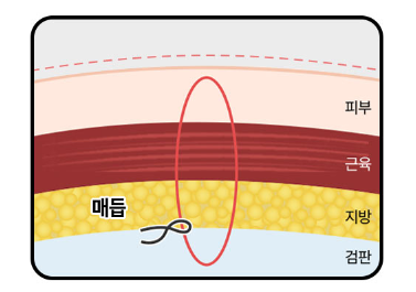 자연스러움을 고려한 비절개 자연유착 쌍꺼풀 관련 이미지 3
