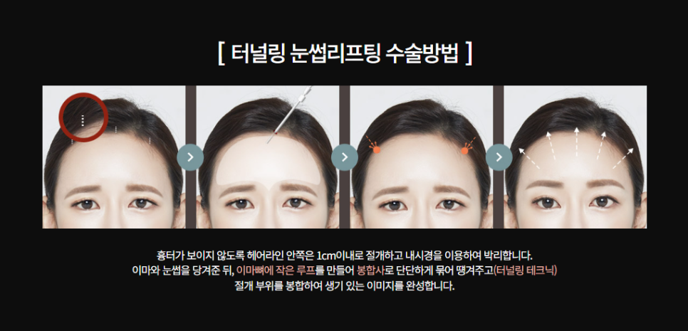 눈성형, 쌍꺼풀 수술 같은 라인도 다르게 보이는 이유는? 관련 이미지 1