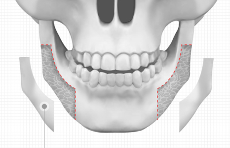What Are the Causes of a Square Jaw, and How Can It Be Improved? image 3
