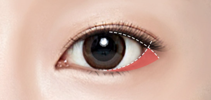 Canthoplasty and Lateral Canthoplasty to Soften the Eyes image 3