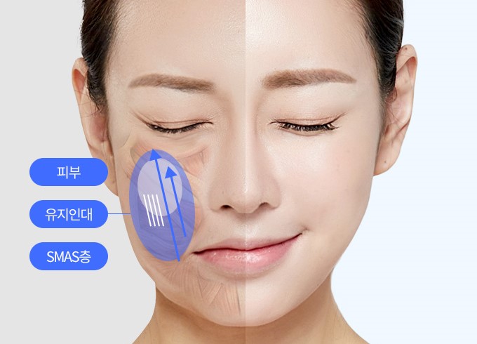 Facelift: Why the SMAS Layer Matters image 4