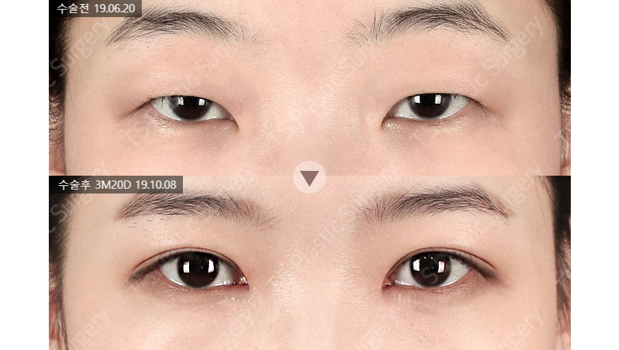 함몰눈은 어떻게 쌍꺼풀 수술을 해야 할까? 관련 이미지 2