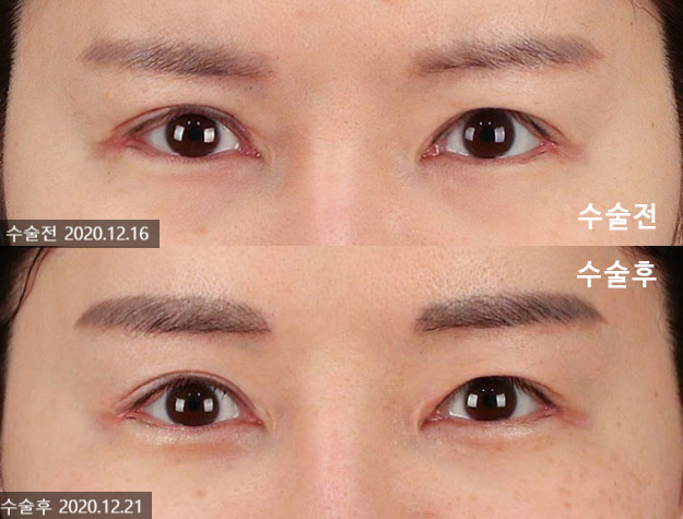 티에스 극한눈 재수술 리뷰(1) 피부부족, 비대칭, 토안증이 심했던 분의 수술전후 변화 관련 이미지 7