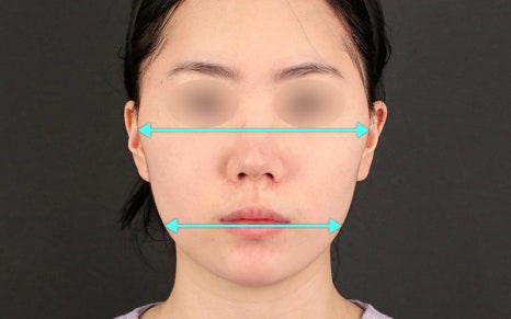 Does Facial Contouring Surgery Always Require All 3 Procedures? Cases Where Zygoma Reduction Surgery Alone Can Create a Smaller, Smoother Face image 1