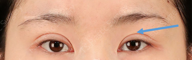 Revision Eyelid Surgery Case: Correcting an Eye Shape That Felt Heavy and Constricted Due to High, Thick Double Eyelids image 1