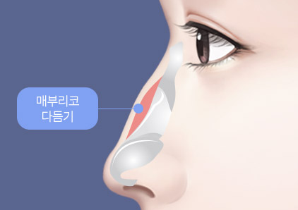 Things to Consider When Thinking About Revision Surgery for a Hump Nose image 6