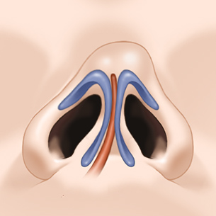 If you are concerned about a crooked nose, consider the degree of deviation, the location, and whether a deviated septum is present image 5