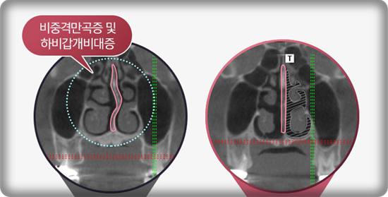 코성형, 얼굴 균형을 고려한 5가지 핵심 포인트 관련 이미지 6