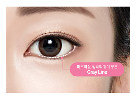 뒷트임, 밑트임, 눈트임 수술로 자연스러운 눈매 교정 관련 이미지 3