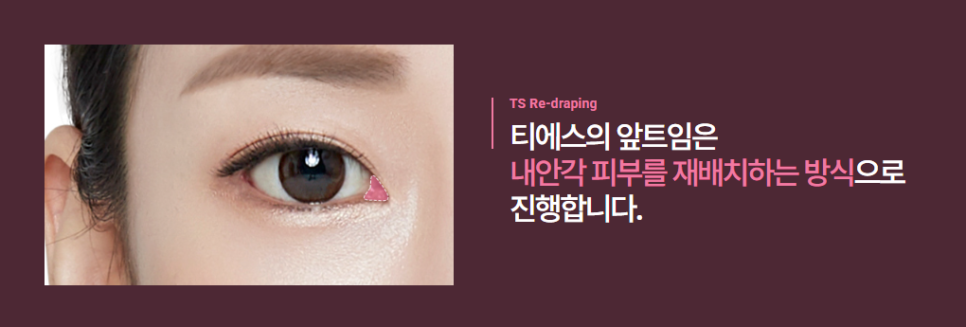 앞트임 수술, 나에게도 꼭 필요할까 수술 장단점, 효과, 추천 대상 총정리 관련 이미지 3