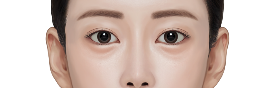 눈밑지방재배치 수술 후 다시 꺼져보인다면? 재발 원인부터 확인해야 합니다 관련 이미지 1