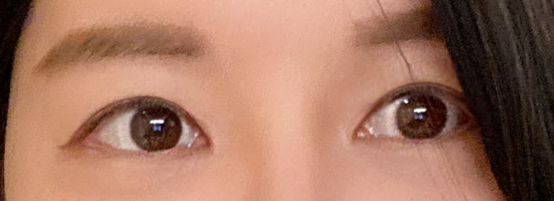 티에스 극한눈 재수술 리뷰(1) 피부부족, 비대칭, 토안증이 심했던 분의 수술전후 변화 관련 이미지 13