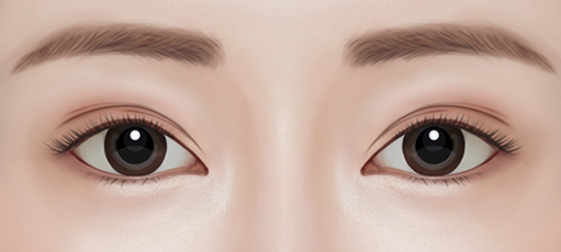 Important Points to Consider When Thinking About Revision Surgery After Eye Surgery image 2