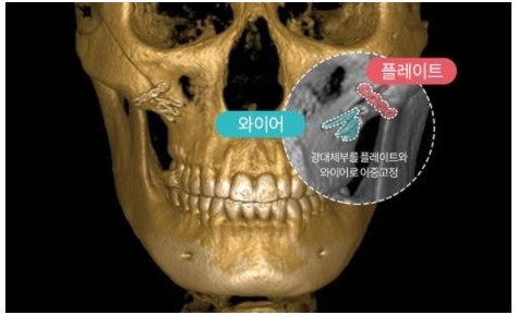 Does Facial Contouring Surgery Always Require All 3 Procedures? Cases Where Zygoma Reduction Surgery Alone Can Create a Smaller, Smoother Face image 8