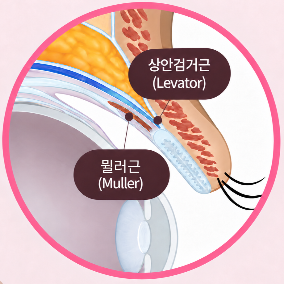 눈매교정 나에게 꼭 필요한 수술일까? 눈 상태에 따른 판단 기준 관련 이미지 2