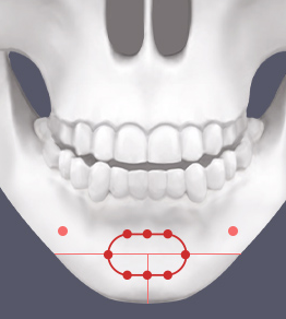 Differences in Preferred Contour Lines for Facial Contouring Surgery in Men and Women image 3