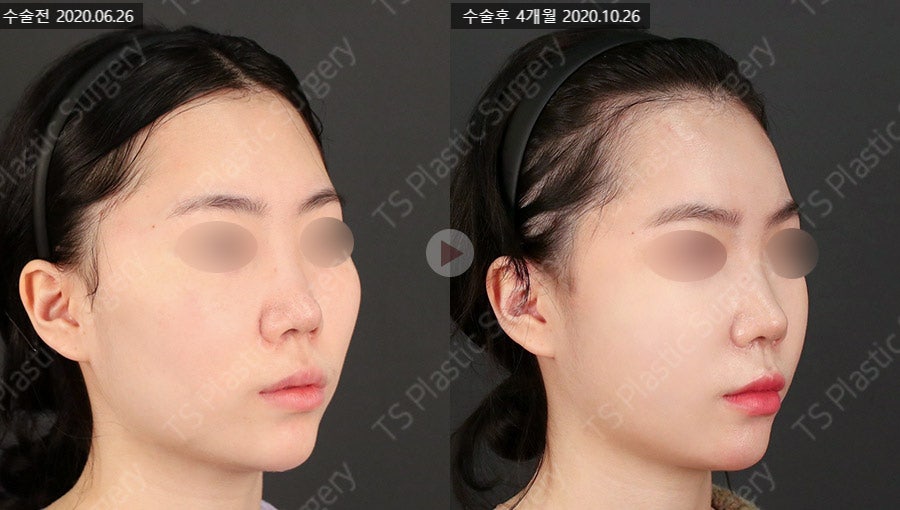 Does Facial Contouring Surgery Always Require All 3 Procedures? Cases Where Zygoma Reduction Surgery Alone Can Create a Smaller, Smoother Face image 5