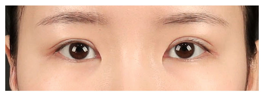 If the double eyelid line is set too thick, how should revision surgery be approached? image 3