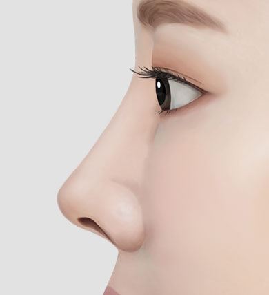 [코수술 리뷰] 낮고 코끝이 들린 짧은코성형 케이스 리뷰 관련 이미지 2