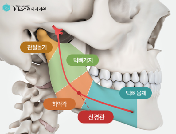 사각턱 축소술 시 고려해야 할 사항과 예방 방법 관련 이미지 2