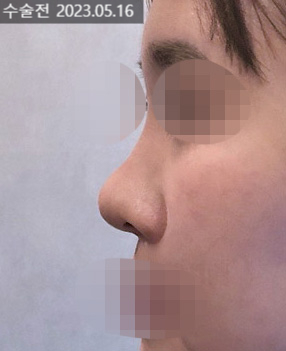 If hump nose surgery and alar reduction are performed together, it may help achieve harmonious facial proportions image 7