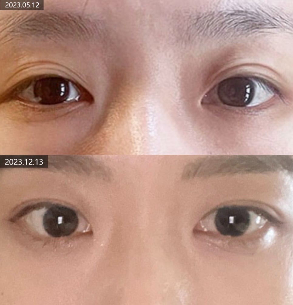 자연유착쌍꺼풀 알아본다면 체크해봐야할 사항 관련 이미지 3