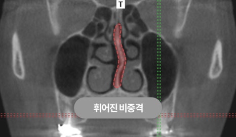 휜코 교정, 개인별 원인 분석이 중요한 이유 관련 이미지 7