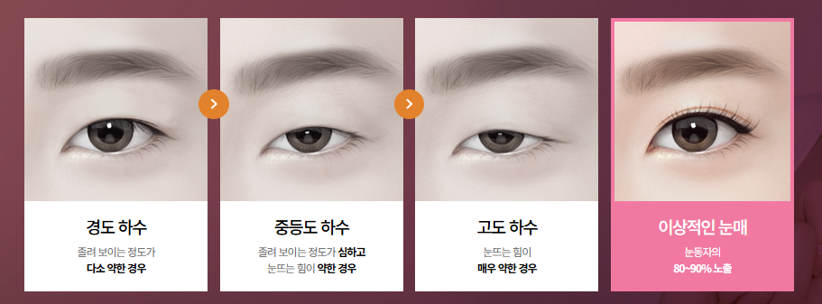 눈매교정으로 보다 선명한 눈매 만들기, 고려할 점은? 관련 이미지 1