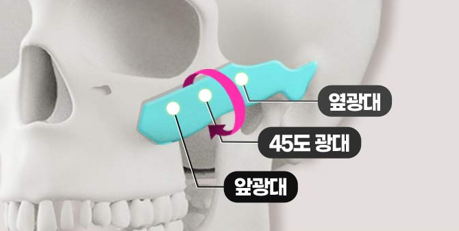 광대축소, 신중한 선택이 중요한 이유 관련 이미지 5