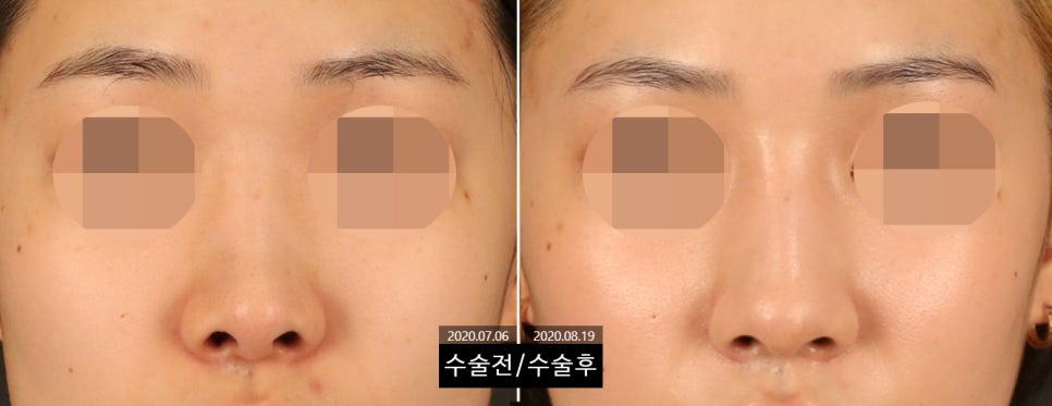 How Can Wide Nostrils Be Corrected? (Effective Bulbous Nose Correction Methods) image 7