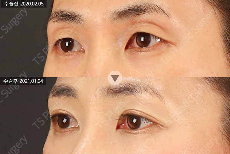 꺼진 눈과 겹주름, 눈두덩이 지방이식 시 주의할 점은? 관련 이미지 2