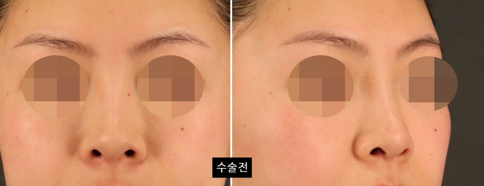 코수술 후 변화가 뚜렷하게 느껴지는 얼굴 유형 4가지 관련 이미지 5