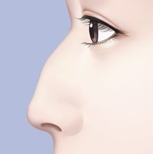 Things to Consider When Thinking About Revision Surgery for a Hump Nose image 1